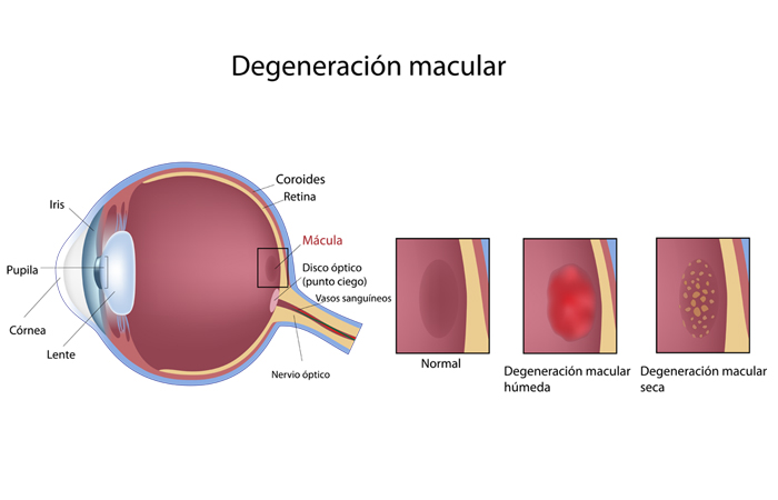 Degeneración Macular - DMAE