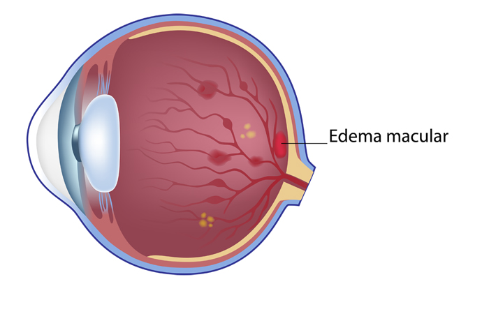 Edema macular diabético