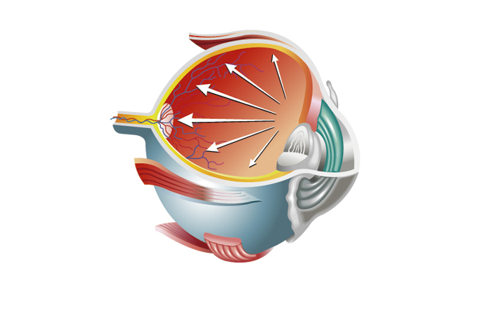 Glaucomas