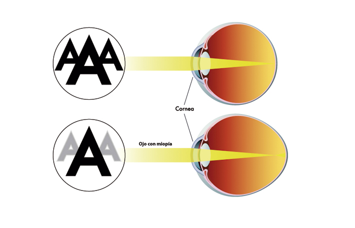 Miopía patológica