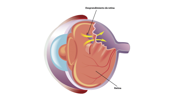 Cirugía de retina
