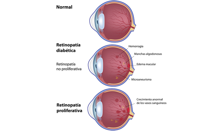 Retinopatía diabética